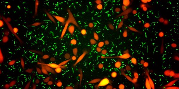 Cancer cells (orange) co-cultured with bacteria (green): many tumours have their own microbiome, which might interact with microbes in other parts of the body. Credit: Straussman Lab/Weizmann Institute of Science