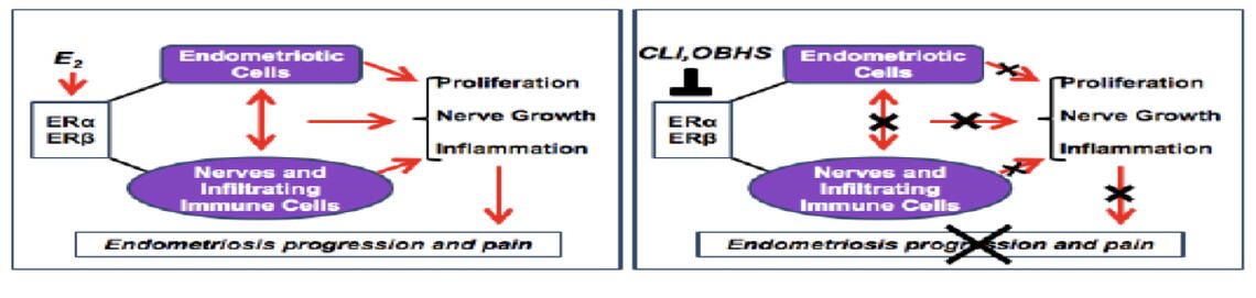 Figure 3: Model showing the contrasting stimulatory effect of estradiol (E2) and suppressive effects of CLI and OBHS on endometriotic lesions in terms of proliferation, nerve growth, and inflammation, and their relationship to endometriosis progression